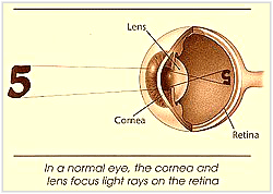 Light rays must be bent so they can focus on the retina