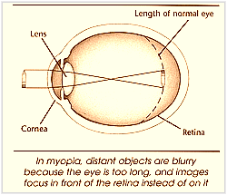 Myopia or nearsightedness